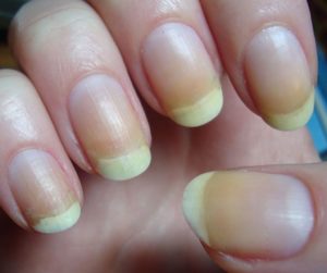 Причины желтых ногтей на руках,  причины 