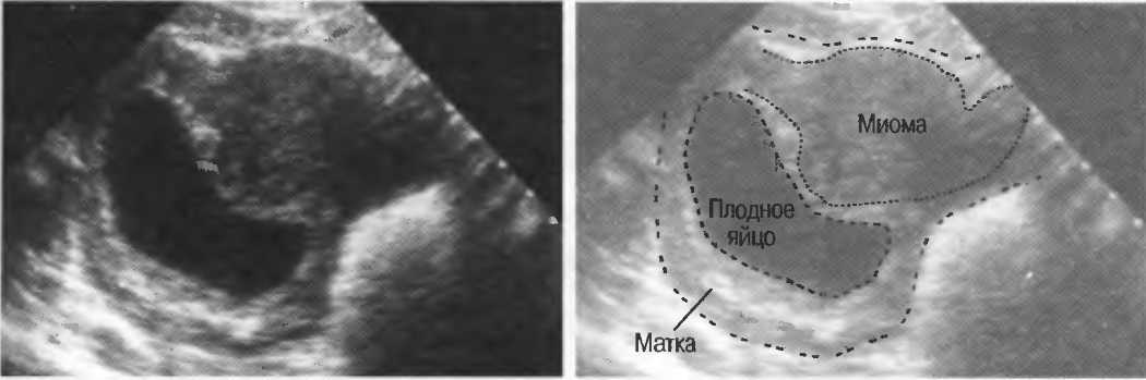 Матка 12 мм. Субмукозная миома матки УЗИ. Миома матки при беременности фото УЗИ.