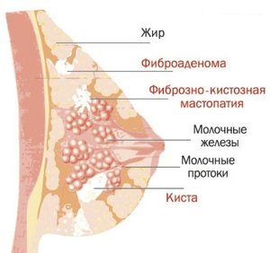 Диффузная кистозная мастопатия молочной железы